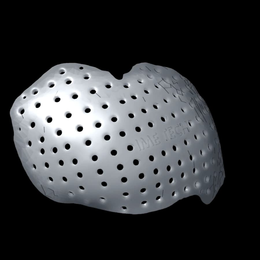 Cranioplastie bifrontale