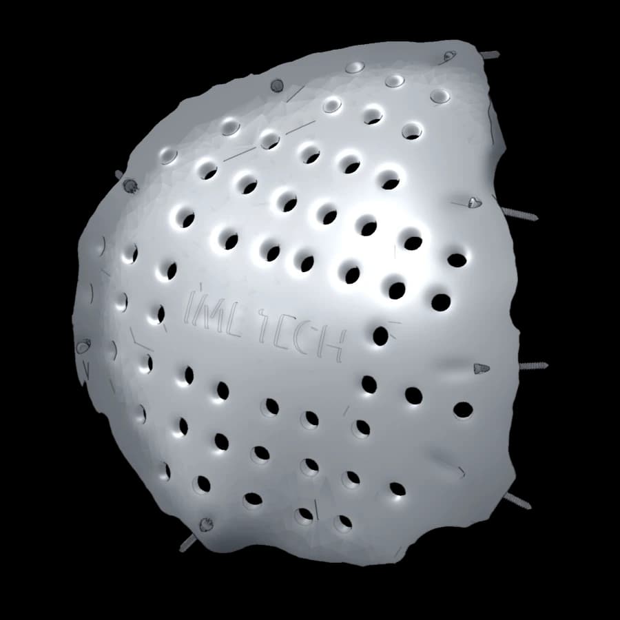 Cranioplastie fronto-temporo-pariétale gauche