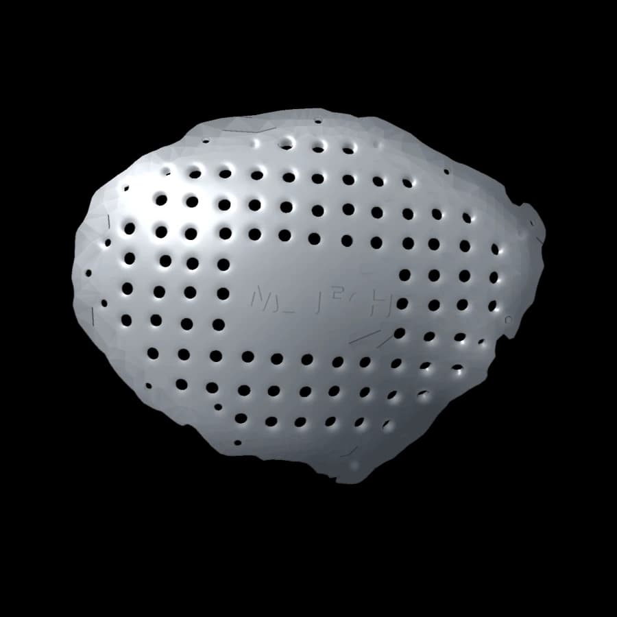 Cranioplastie fronto-temporo-pariétale